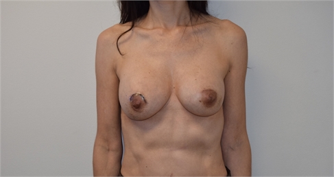 breast reconstruction Before