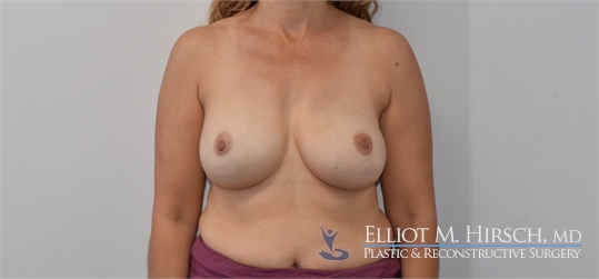 Two Stage Breast Reconstruction After