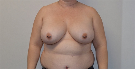 Two Stage Breast Reconstruction Before