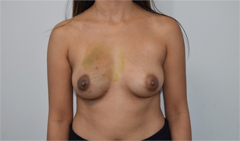 breast reconstruction Before