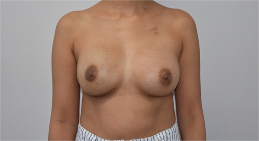 breast reconstruction After