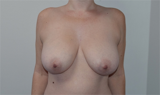 Breast Reduction Before