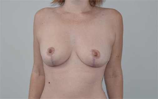 Breast Reduction After