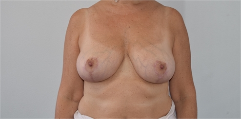 Breast Reduction After