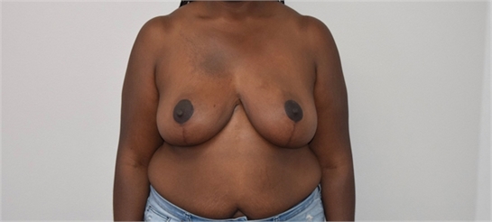 Breast Reduction Before and After Los Angeles After