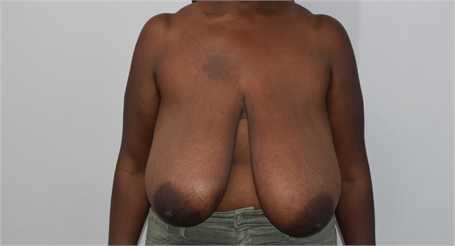 Breast Reduction Before and After Los Angeles Before