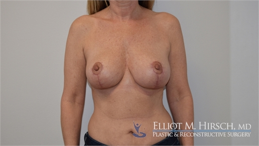 Breast Reduction After