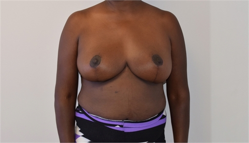 Breast Reduction After