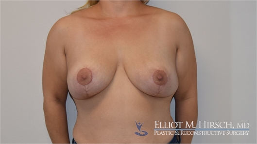 explant and mastopexy After