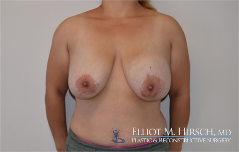 explant and mastopexy Before