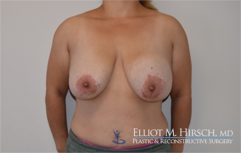 Breast Implant Revision Before