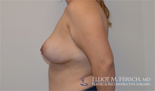 Breast Implant Revision After