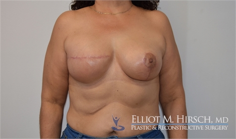 Two Stage Breast Reconstruction After