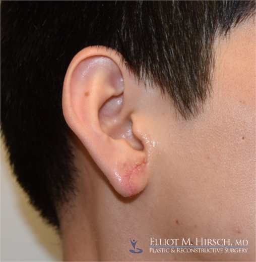 Split Earlobe Repair LA After