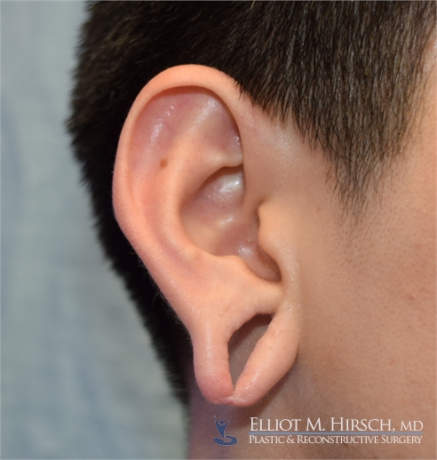 Split Earlobe Repair LA Before