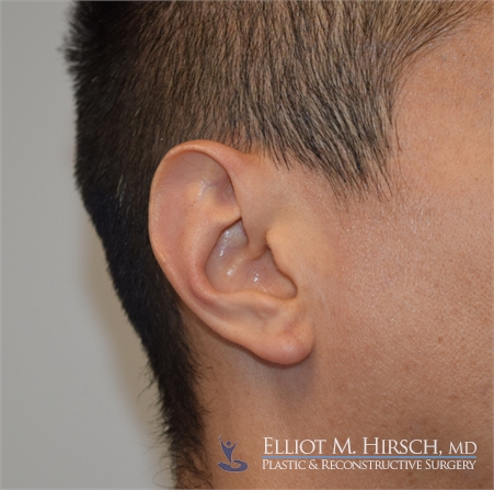 Split Earlobe Repair Los Angeles After