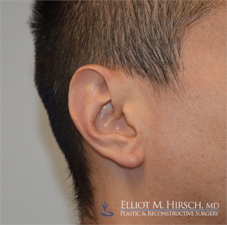 Split Earlobe Repair After