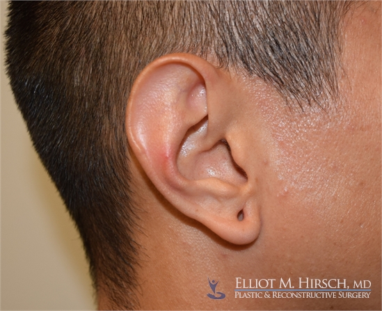 Split Earlobe Repair Before