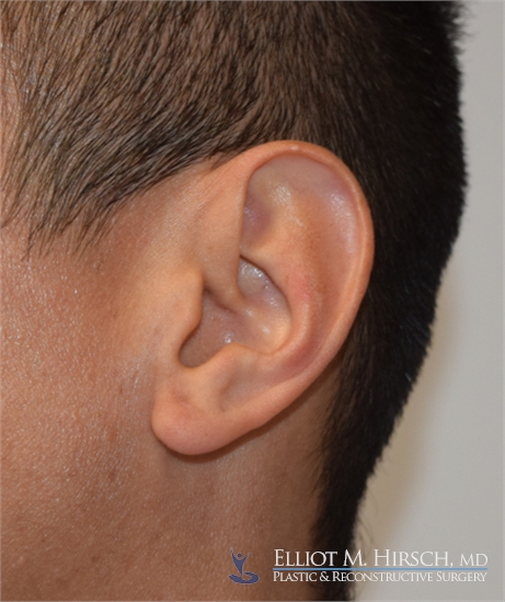 Split Earlobe Repair After