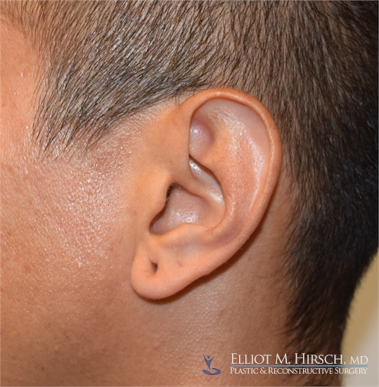 Split Earlobe Repair Before