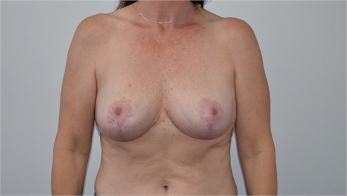 explant and mastopexy After