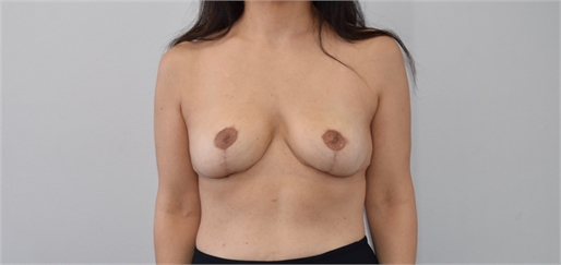 explant and mastopexy After