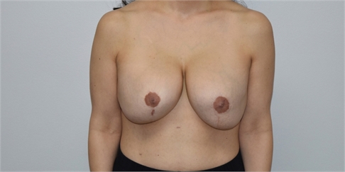 explant and mastopexy Before