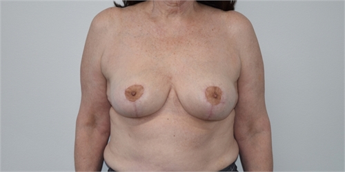 explant and mastopexy After