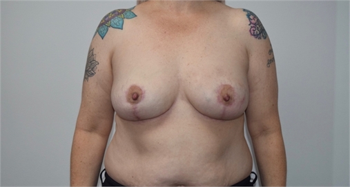 explant and mastopexy After