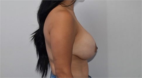 explant mastopexy Before