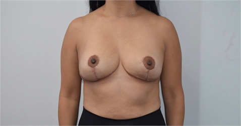 explant mastopexy After