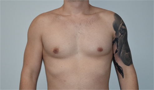 gynecomastia After