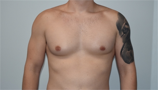 gynecomastia Before