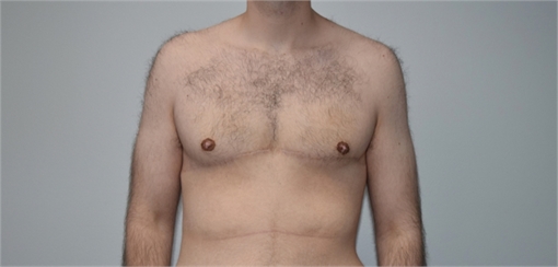 Gynecomastia After