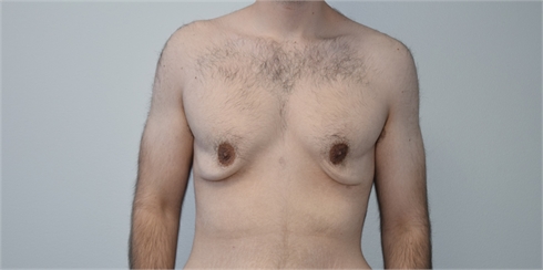 Gynecomastia Before