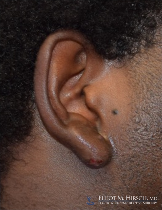 Los angeles keloid treatment patient After