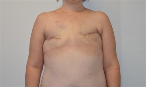 Breast Reconstruction Revision Before