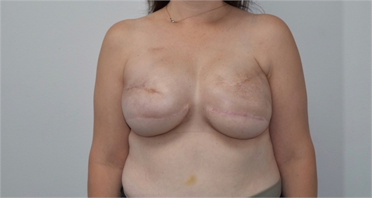 Breast Reconstruction Revision After