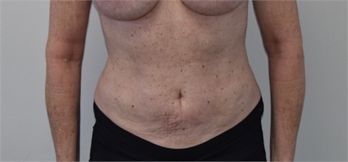 liposuction After