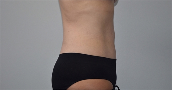 Mini tummy tuck After