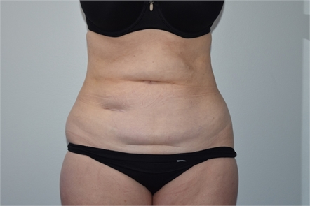 Mini tummy tuck Before