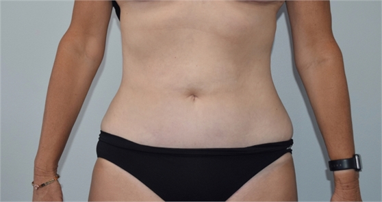 Mini tummy tuck After
