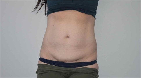 Mini tummy tuck Before