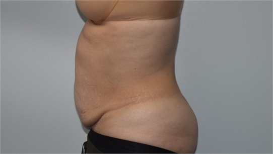 Mini tummy tuck Before