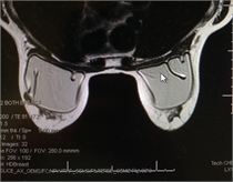 Capsular Contracture Treatment