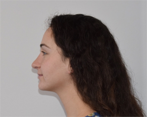 Rhinoplasty After