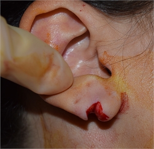 Ripped earlobe deals from earrings