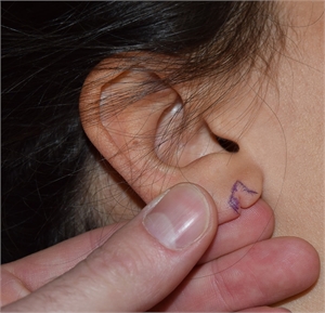 Split Earlobe Repair Los Angeles