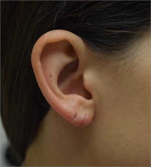 Image related to Split Earlobe Repair Los Angeles