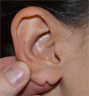 Image related to Split Earlobe Repair Los Angeles